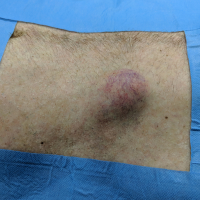 Holby City Inguinal Hernia