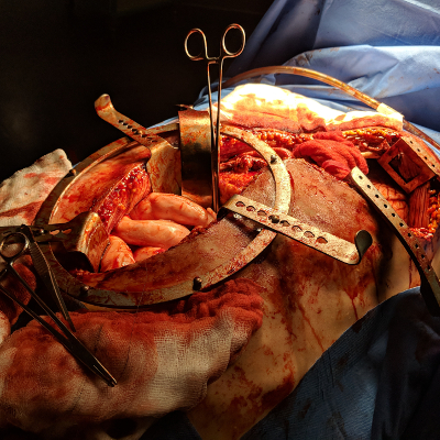 Holby City Road Traffic Accident Op